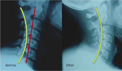 Before and after X-ray, sublaxation spine