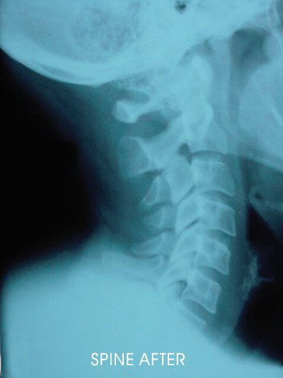 Spine After